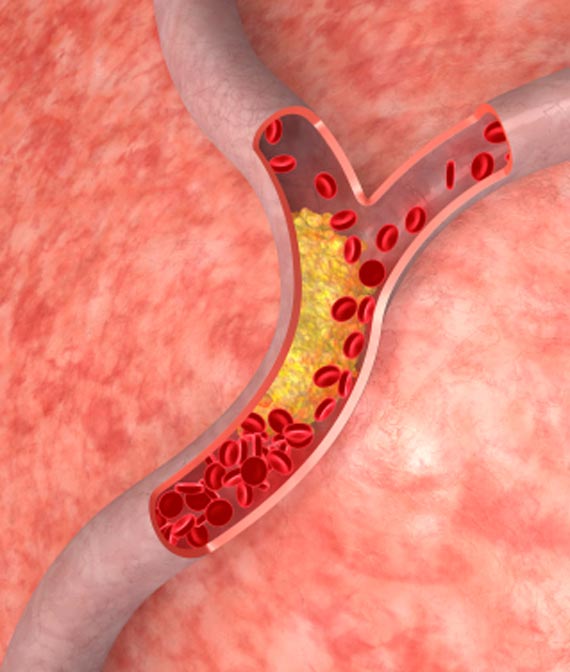 Cholesterol_test